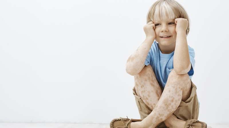 Dia Mundial do Vitiligo: preconceito é a maior luta a ser enfrentada pelos pacientes, destaca especialista