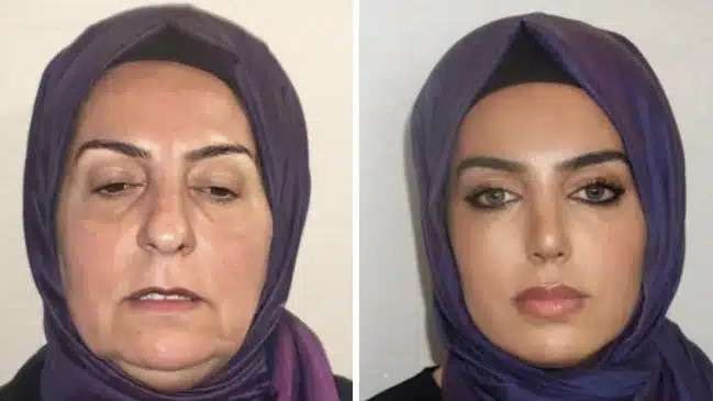 Resultado de cirurgia plástica em jovem de 68 anos levanta dúvidas sobre autenticidade