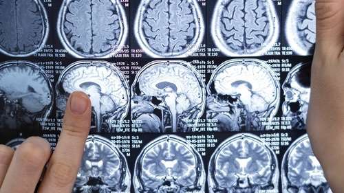 Dia Mundial do AVC: Quase 89 mil mortes no Brasil em 2023 devido a acidente vascular cerebral