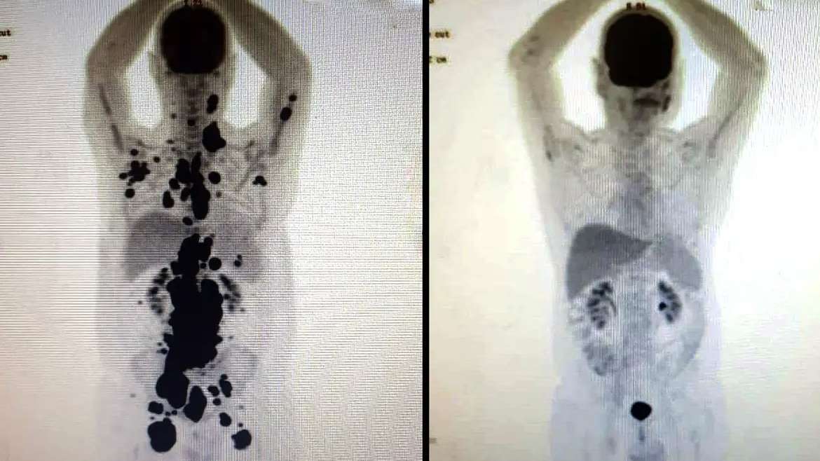 Revolucionando o combate ao câncer: Desvendando a eficiência da terapia celular CAR-T