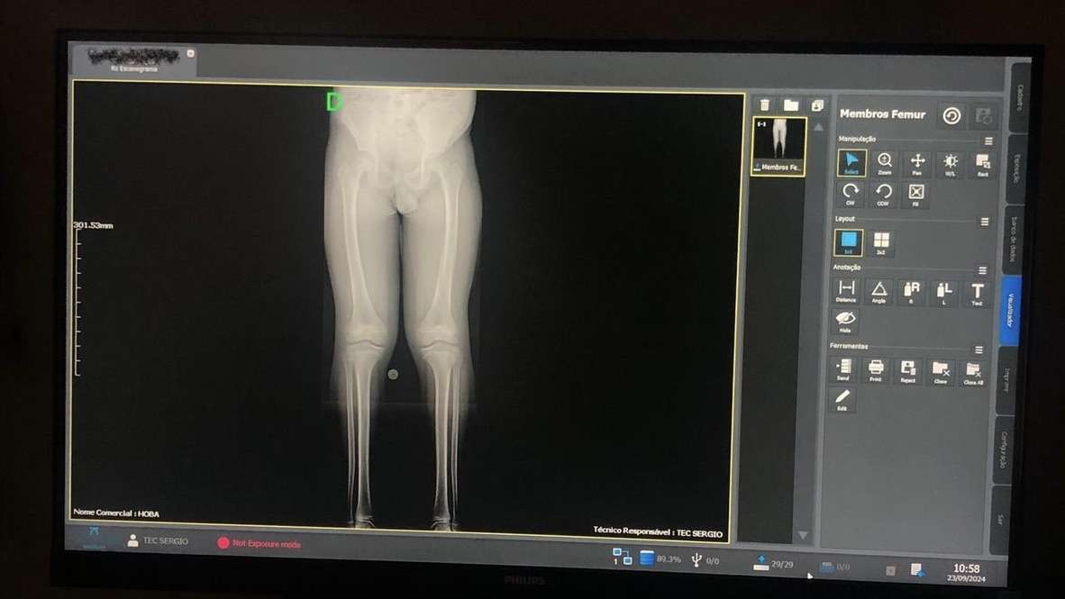 Hospital Ortopédico do Estado da Bahia introduz exame inédito no SUS para diagnóstico de alterações ósseas.