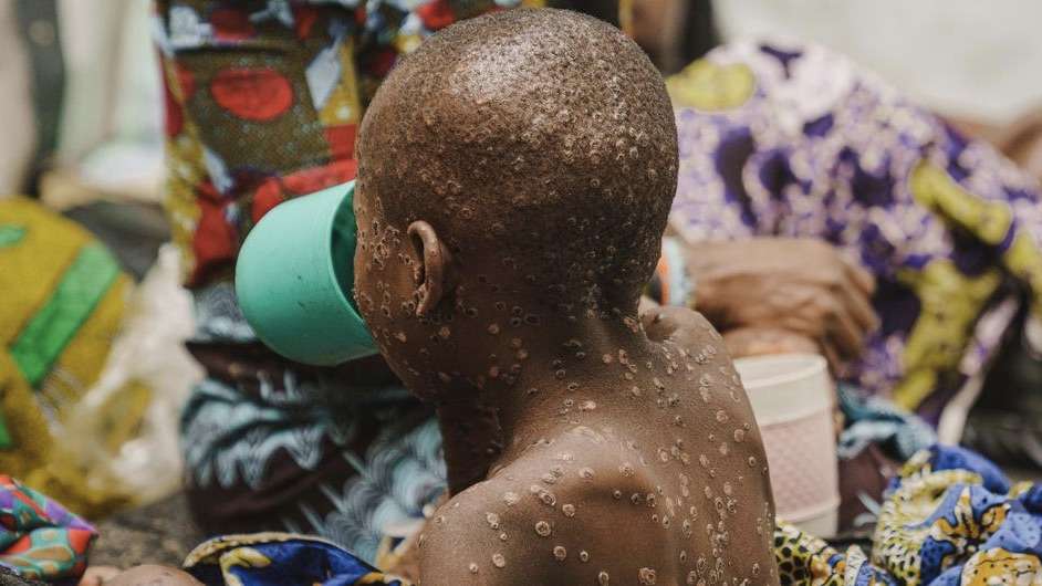 Casos de mpox atingem 60 países; África central concentra maior número de infecções.