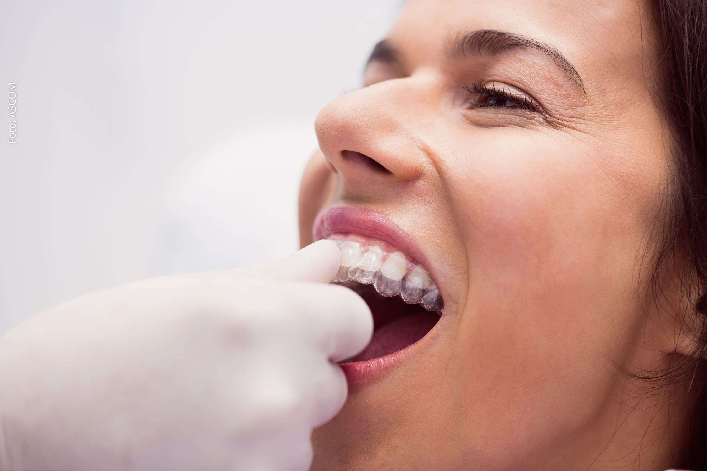 Clareamento dental ganha popularidade no Brasil e exige acompanhamento profissional, alerta cirurgião-dentista