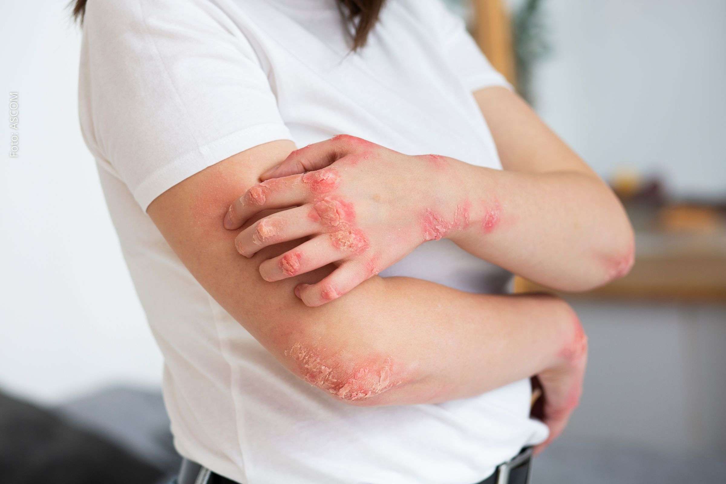 Psoríase afeta 5 milhões de brasileiros e tem tratamento eficaz, alerta dermatologista