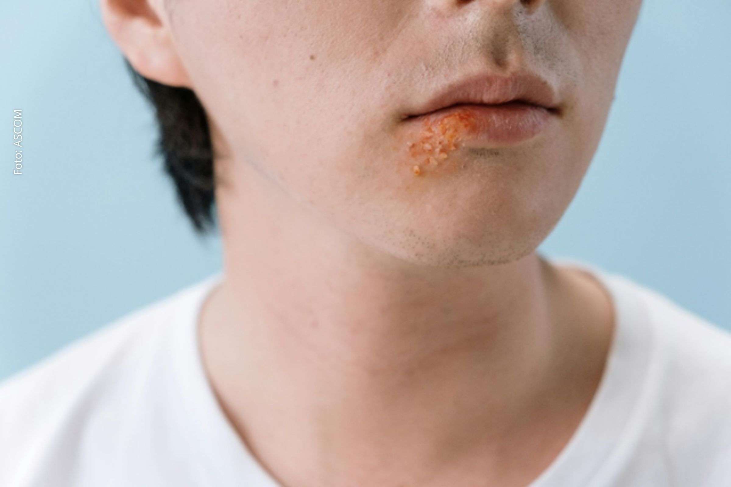 Carnaval 2026: 6 dicas de saúde bucal ajudam a prevenir sapinho, cáries e infecções durante a folia
