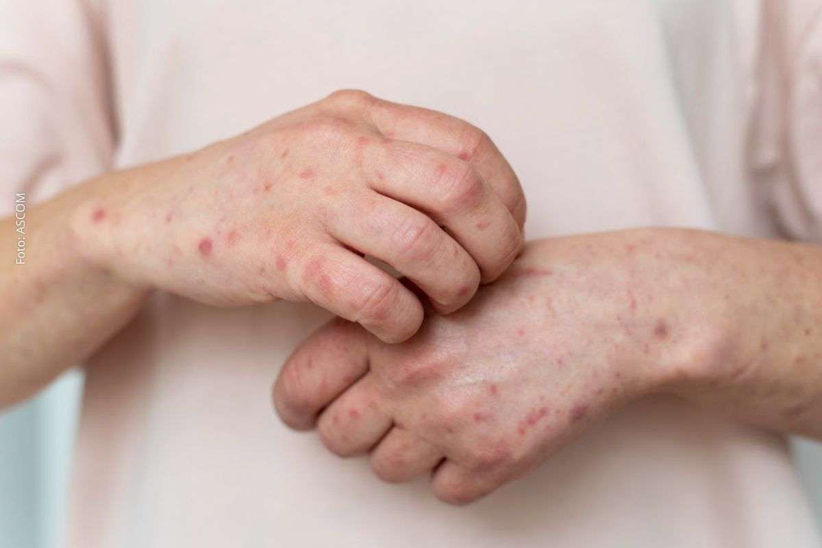 Mpox no Brasil: Ministério da Saúde confirma 140 casos em 2026 e especialistas alertam para sintomas na pele, mucosas e olhos