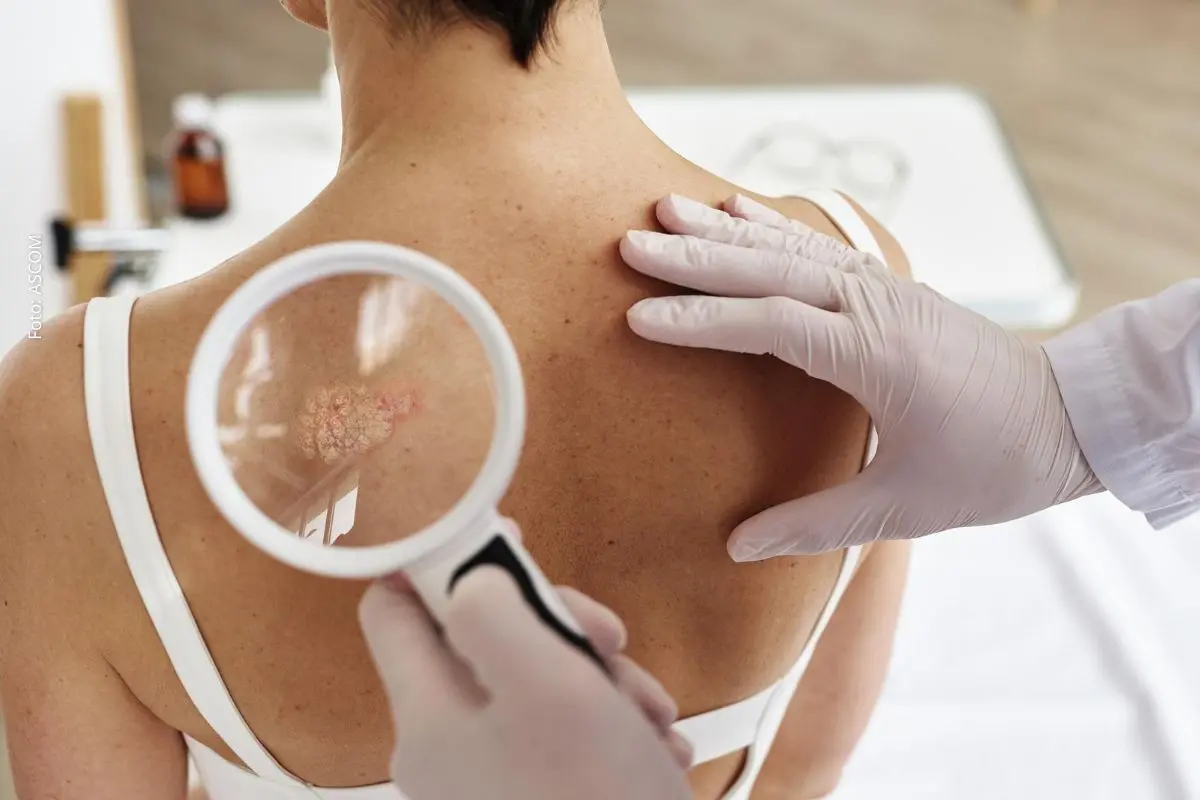 Campanha Maio Sem Cor promove ações gratuitas de prevenção ao câncer de pele em Salvador e amplia debate sobre diagnóstico precoce